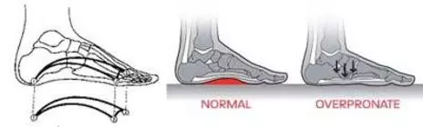 Fénykép: A lúdtalpA leggyakoribb, népbetegségszámba menő statikai lábbetegség a lúdtalp, a láb hosszanti boltozatának a lelapulása. Tünetei a sarok befelé dőlése, hossz és harántboltozat lesüllyedése, fáradékonyság, láb és lábszárfájdalom.A láb fejlődési zavarai következtében is kialakulhat, de többnyire túlterhelésre, a mesterséges körülmények okozta terhelés, vagy helytelen irányú igénybevétel hatására fejlődik ki.Gyermekkor bizonyos periódusában különösen nagy a lúdtalp kialakulásának veszélye.Azok az időszakok, amikor a gyermek lábát hirtelen fokozottabb terhelés éri, a következők:1.	Állás, járás kezdete.2.	Óvodáskor, iskoláskor kezdete.3.	A serdülőkori gyors növekedés és súlygyarapodás szintén nagy megterhelést jelent.4.	A mozgás hiánya, egészségtelen életmód.5.	Nem megfelelő cipő viselete. A sarkat befelé döntő cipő elősegíti a hosszanti boltozat lelapulását, úgyszintén a fokozott cipősarok emelés a harántboltozat süllyedését segíti elő.A felnőttkori elváltozások gyakran már a serdülőkorban kezdődnek. Ha már a fiatalkorban észlelt panaszokhoz nagy testsúlynövekedés és tartós állással járó munkakör is társul. A láb képtelen megfelelni a vele szemben támasztott követelményeknek és statikus lábdeformitás, lúdtalp kialakulásával kell számolnunk.A kóros statikai viszonyokat a lábizomzat kezdetben aktívan korrigálja. Az izomzat kifáradása után a szalagok is megnyúlnak, és létrejön a jellegzetes lábdeformitás.Kisgyermekkorban a belső cipősarok emelése, vagy talpbetét használatával korrigálhatjuk a sarok befelé dőlését és ezzel egyidejűleg kialakulhat a hosszanti lábboltozat. Fontos tehát a helyes sarokállás biztosítása. Ugyanilyen fontos a lábizomzat erősítése, a rendszeres lábtorna. Naponta 2x 15-20 percig lábujjhegyen járás, lábujjhegyre állás. Ha megfelelő cipő és lábtorna ellenére panaszos a gyermek, talpbetét viselése ajánlott. A láb növekedésének megfelelően a talpbetétet cserélni kell, az izomzat erősödése 10-12 éves korig várható.Irodalom:Dr. Vizkelety Tibor:   Gyermekortopédia (1976)Dr. Gáspárdy Géza:    A láb mozgásszervi betegségei (1998)Dr Perlaky GyörgyOrtopéd szakorvos